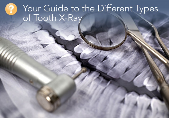 Your guide to tooth x-rays