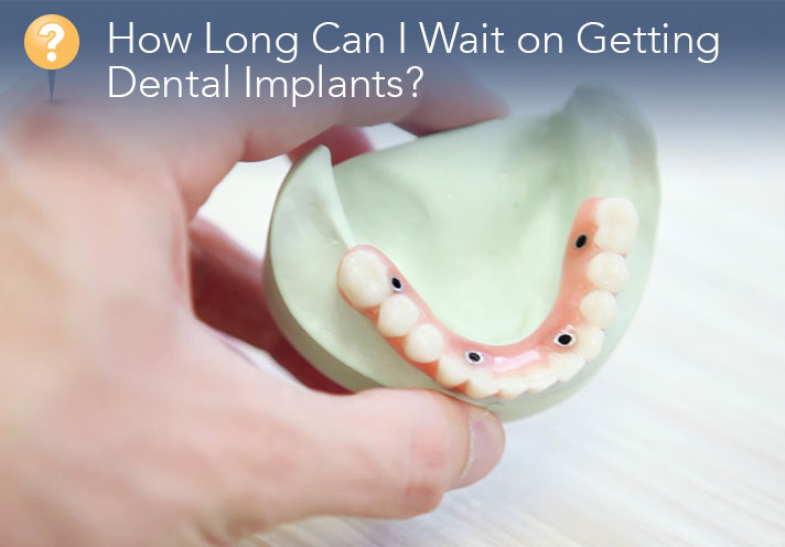 How Long Can I Wait on Getting Dental Implants?