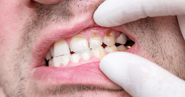 Chipped Tooth in Oral Conditions