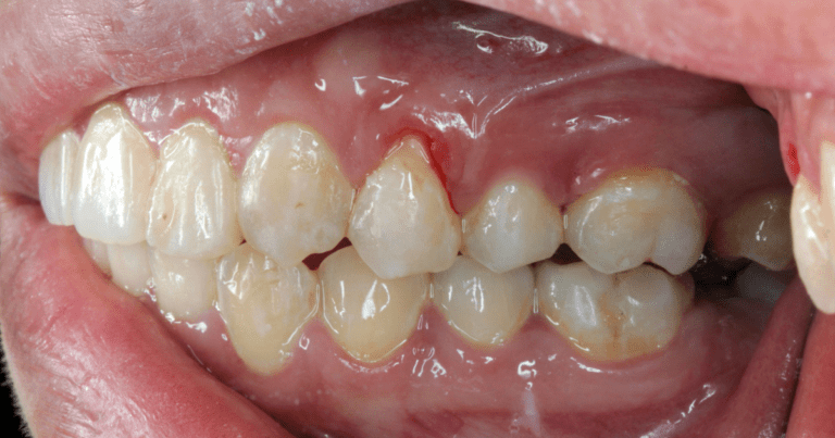 Gum Recession in Oral Conditions