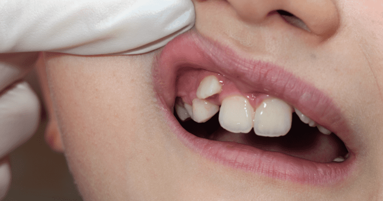 Malocclusion in Oral Conditions