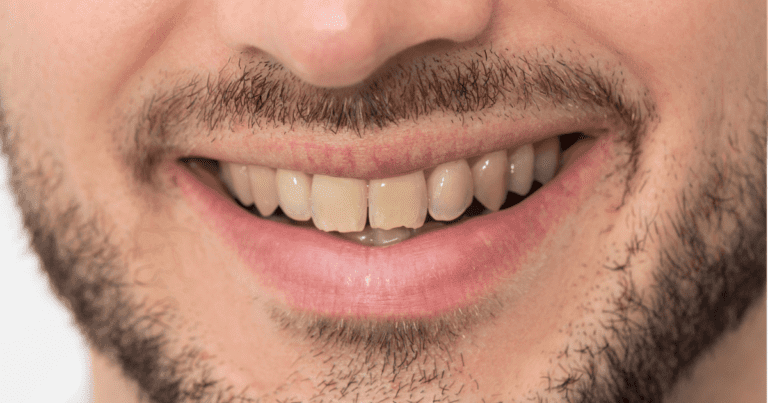Tooth Discoloration in Oral Conditions