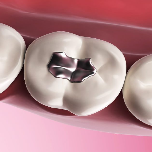Amalgam Filling
