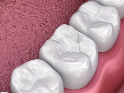 Tooth-Colored Fillings (Composite Fillings)