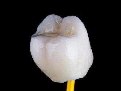 Porcelain Crowns