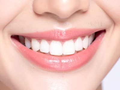 Snap-On Smile