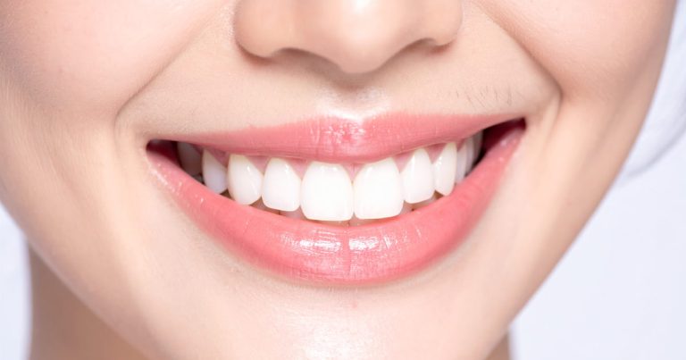 snap-on smile