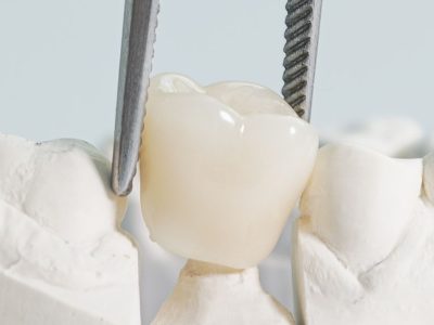Zirconia Crowns