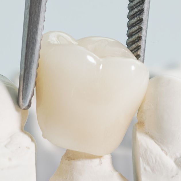 Zirconia Crown